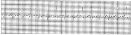 ELECTROCARDIOGRAMA